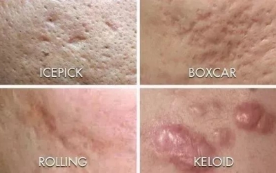 如何祛除痘坑？祛除痘坑最好的方法