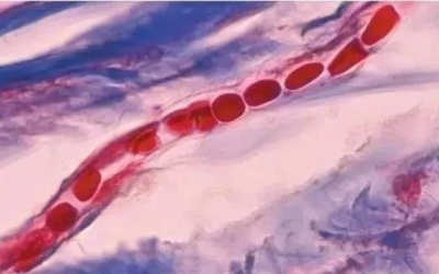 紅血絲是什么原因?qū)е碌?？紅血絲形成的原因！