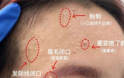 臉上經(jīng)常長(zhǎng)閉口粉刺的原因有哪些？