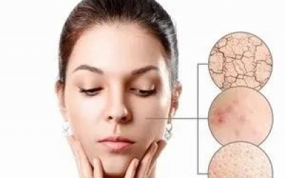 什么是春敏？如何預(yù)防春敏？