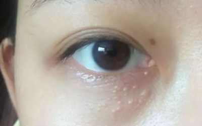 為什么眼部容易長脂肪粒？